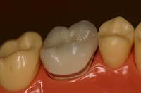 �n�C�u���b�h